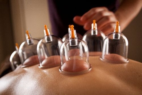 Cupping Therapy
