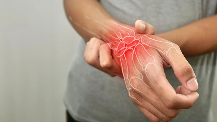 Rheumatoid Arthritis