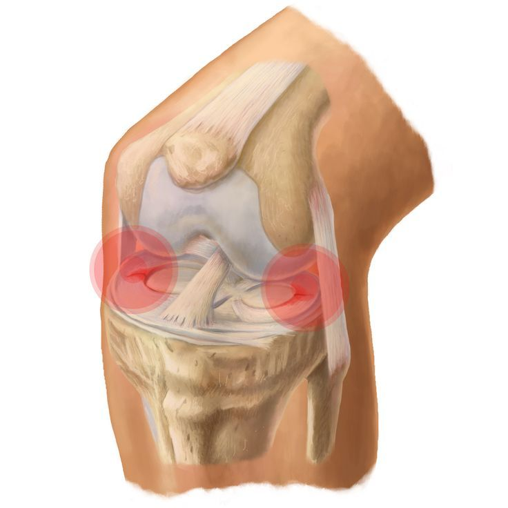 Meniscal Injuries